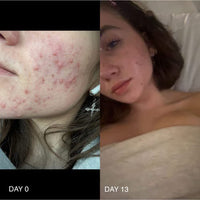  Avant et après. baume anti acné naturel.
