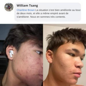 baume tueur d'acné visage,
 avant et après 